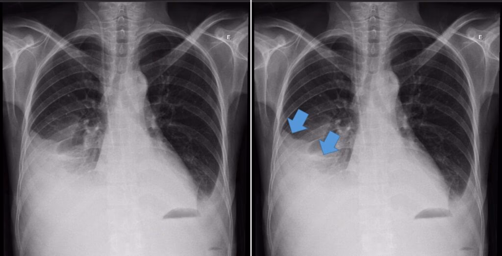Quais são os fatores de risco para derrame pleural?