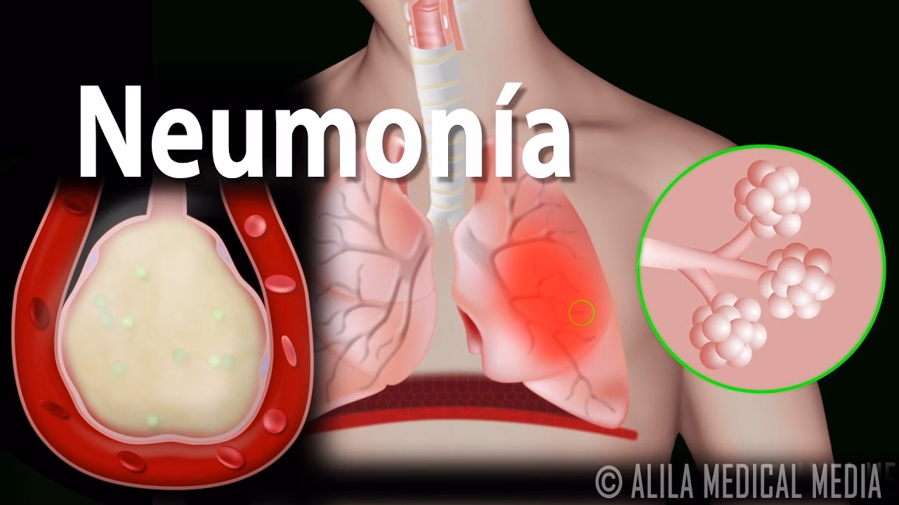 ¿Qué es la neumonía en paciente inmunodeprimido?