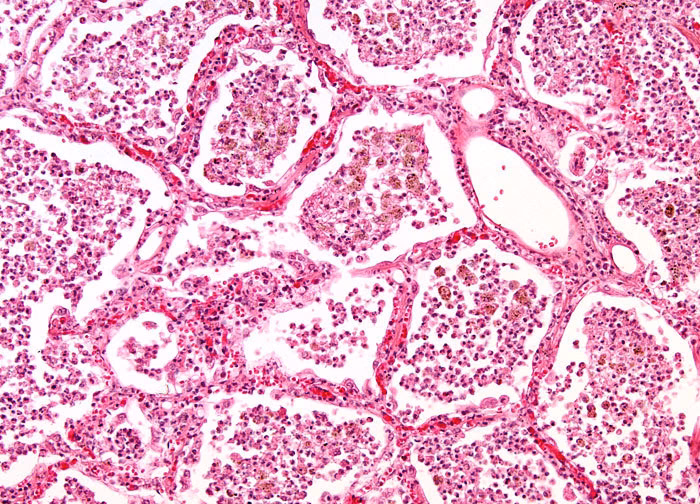 What are the cytologic and histologic features of HMPV pneumonia?