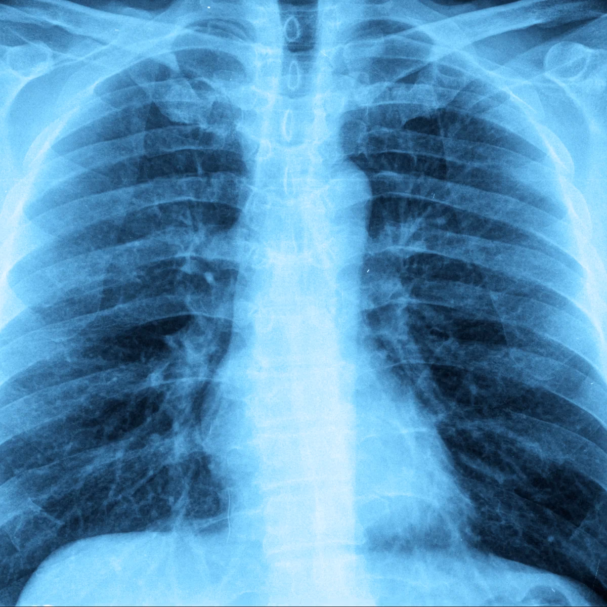 What should I do if I have pneumonia?