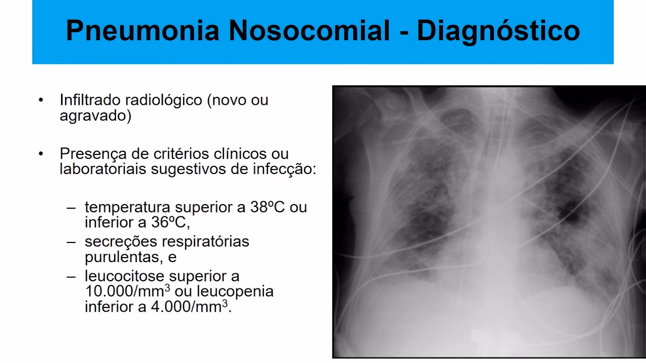 How to prevent nosocomial pneumonia in hospitals?