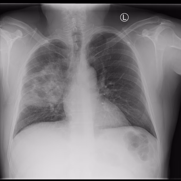 How does lobar pneumonia affect the lungs?