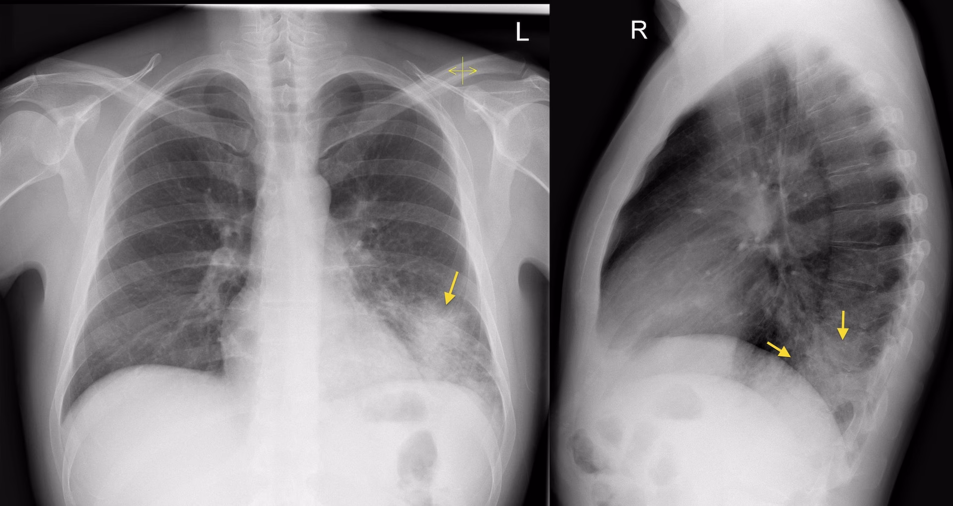 What are the different imaging patterns of pneumonia?