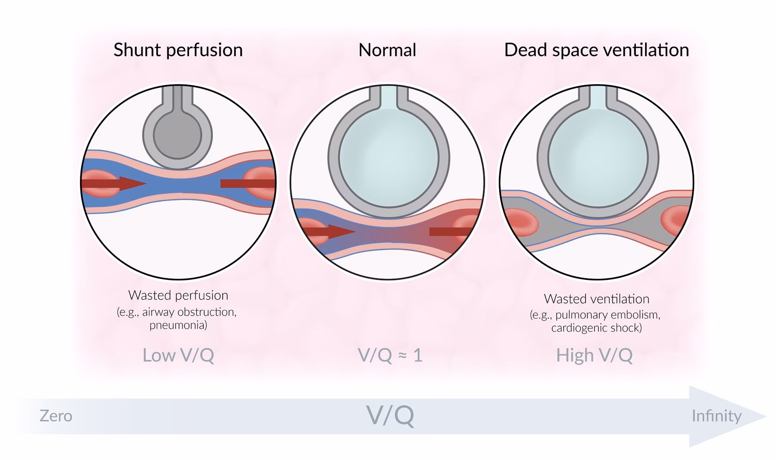 How does the ratio of V to Q affect lungs?