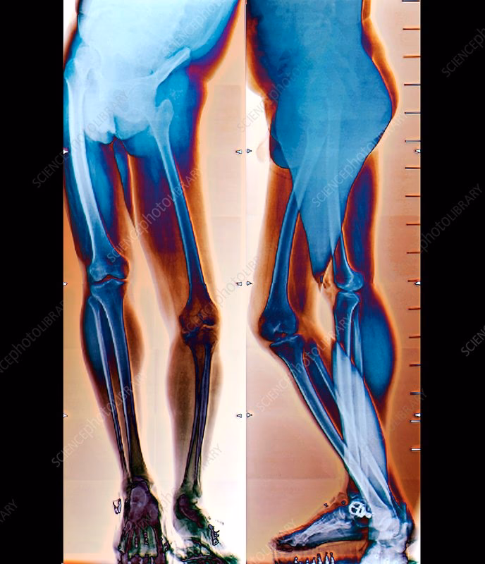 What are the treatment options for foot deformities from poliomyelitis?