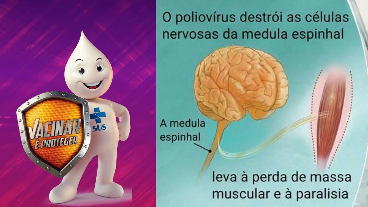 Quais são os sintomas da poliomielite não paralítica?