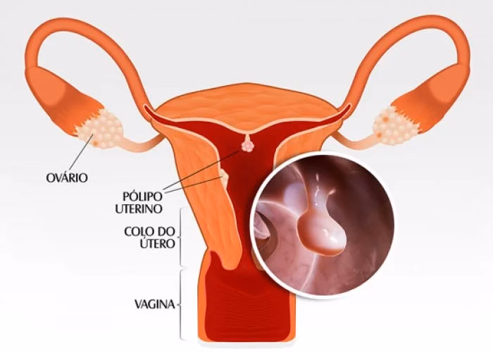 Quais são os pólipos mais perigosos?