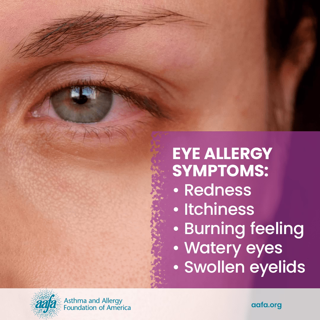 How do allergic reactions affect the eyes?