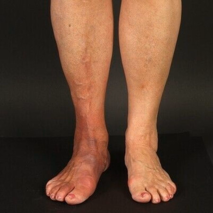 Was ist das Post-Lyme-disease-Syndrom?