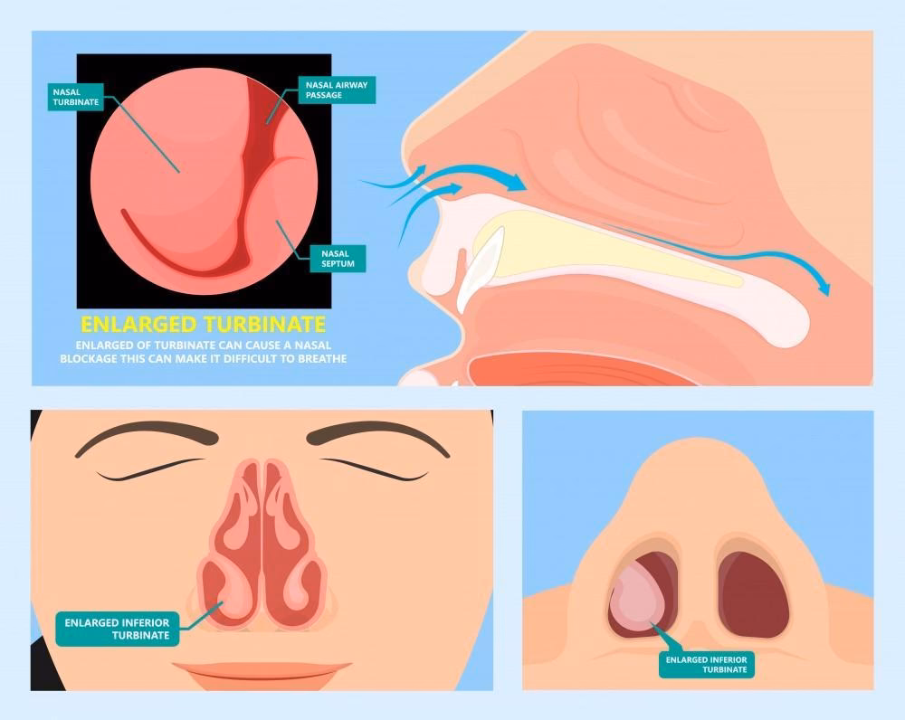 How to treat allergic rhinitis & postnasal drip?
