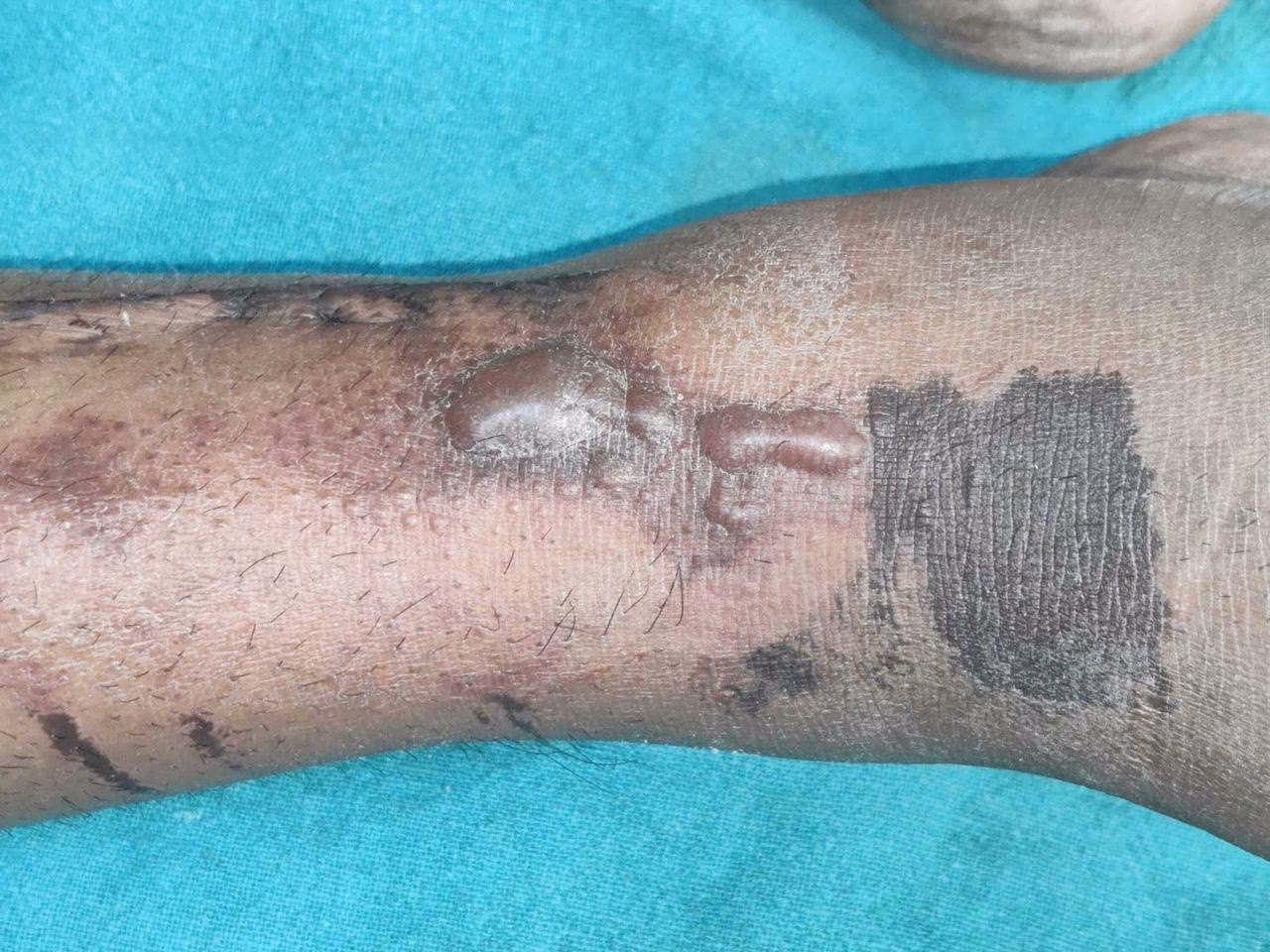 Can SPT be used if you have an allergy to povidone?