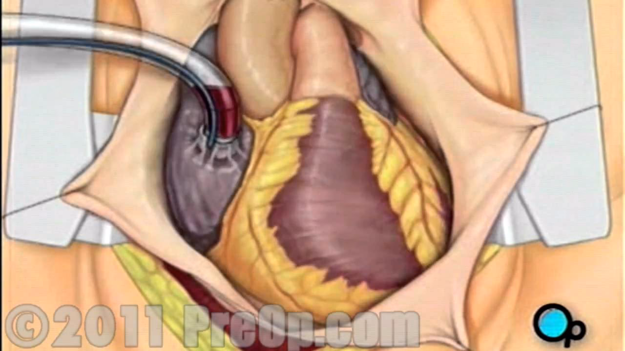 Does pre-operative education improve post-operative outcomes?