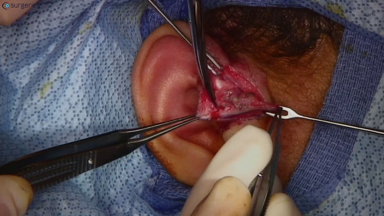 Can A preauricular sinus recur after a complete excision?