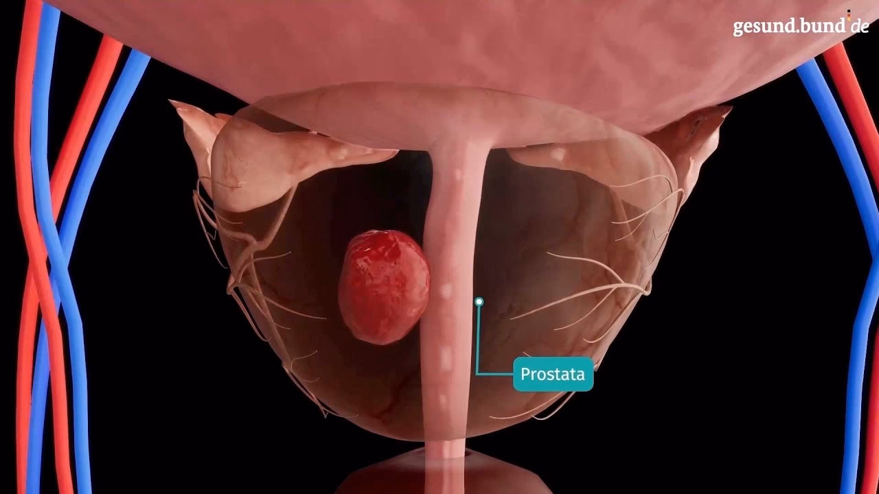 Wie lange dauert eine Prostataentfernung?