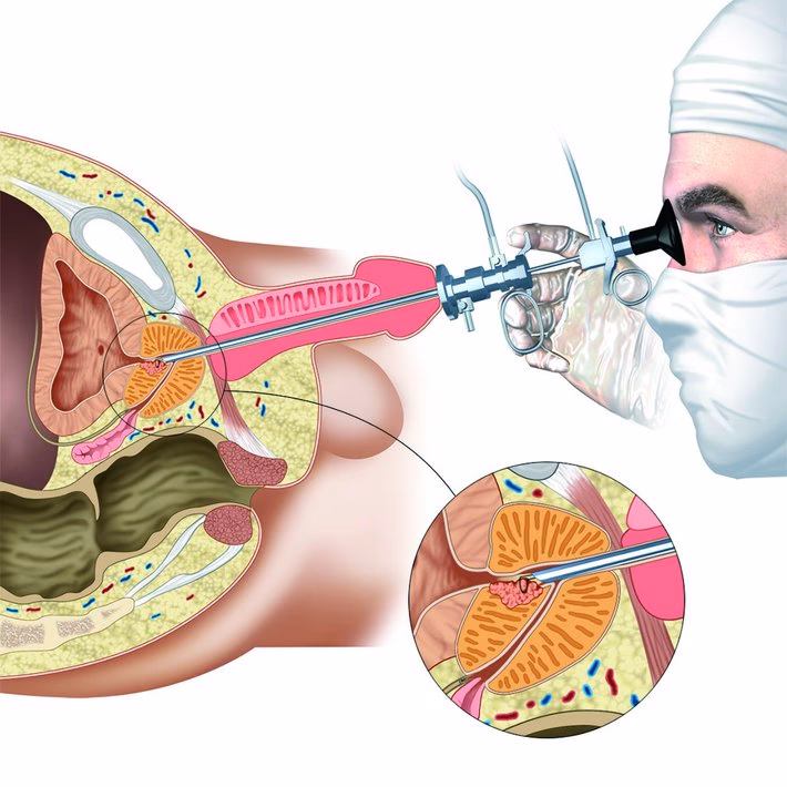Wie wird die Prostata operiert?
