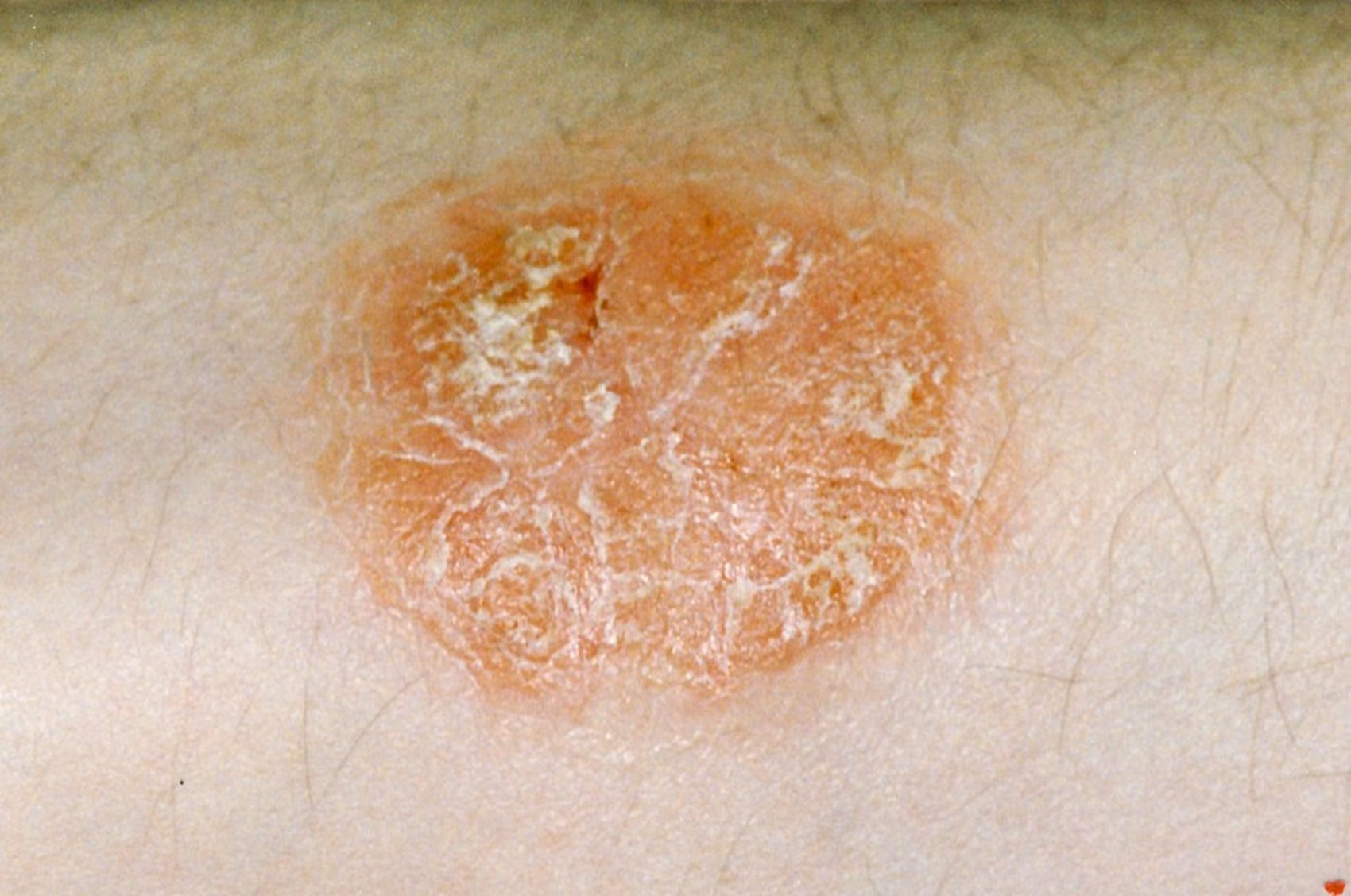 Does psoriasis impact quality of life?