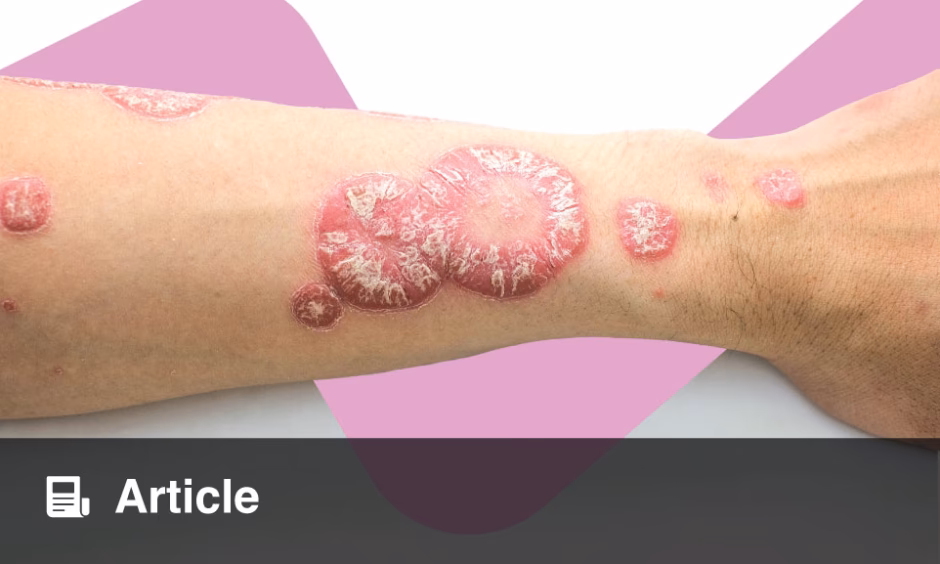 What is ICD-9 code 696.1 for other psoriasis?