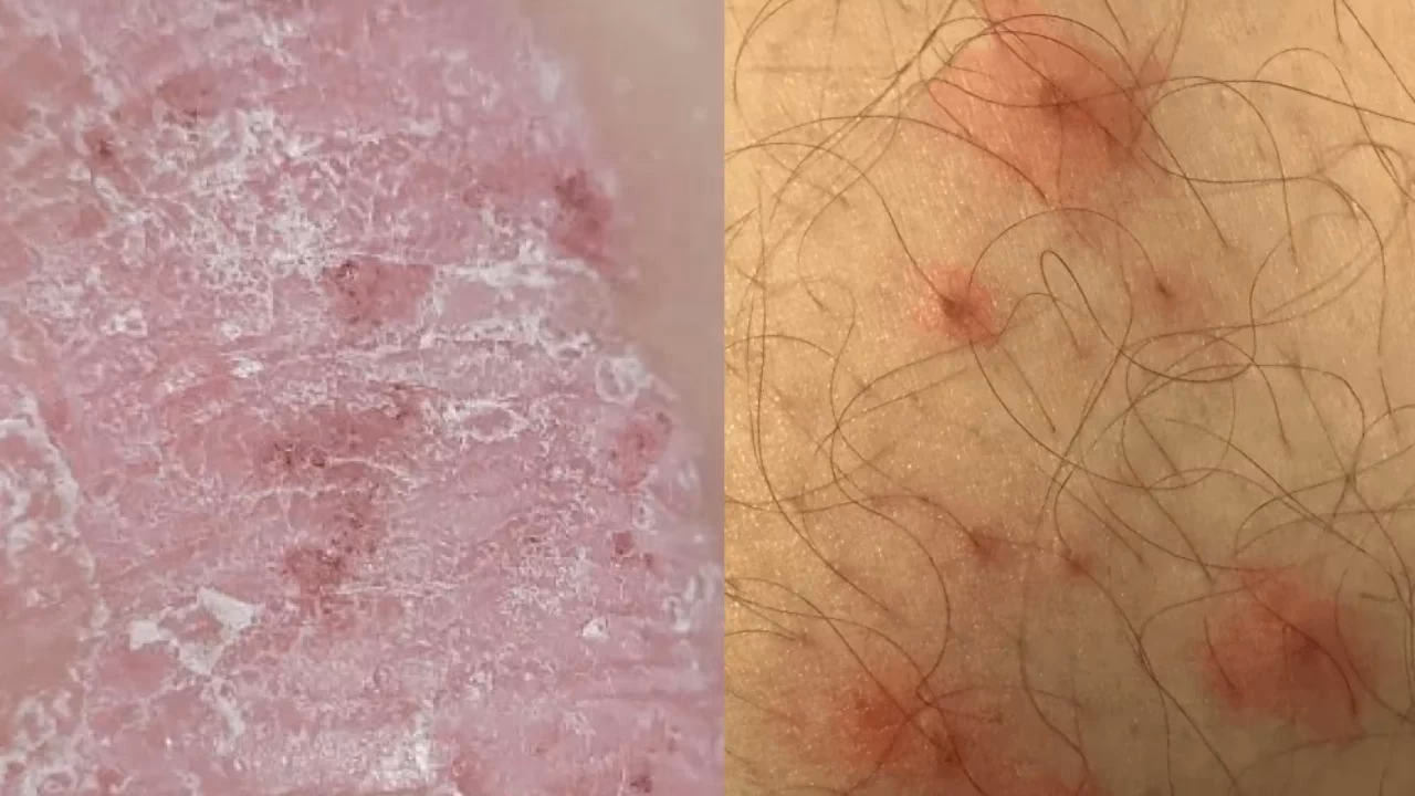 What are the symptoms of psoriasis?