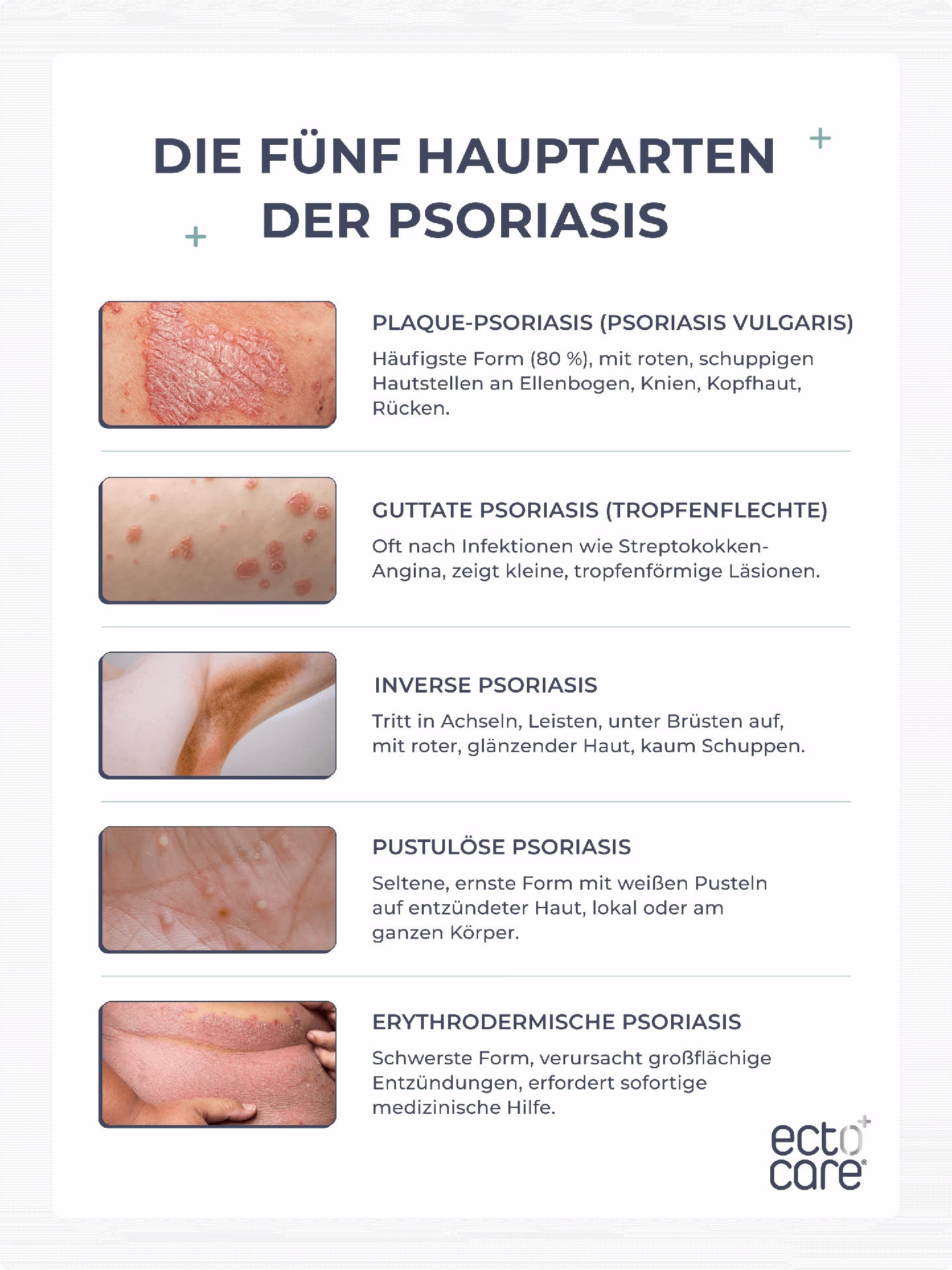 Was ist eine provozierte Psoriasis?
