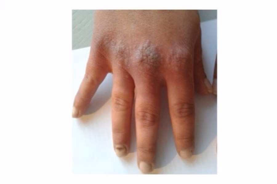 Was ist der Unterschied zwischen rheumatoiden und Psoriasis-Arthritis?