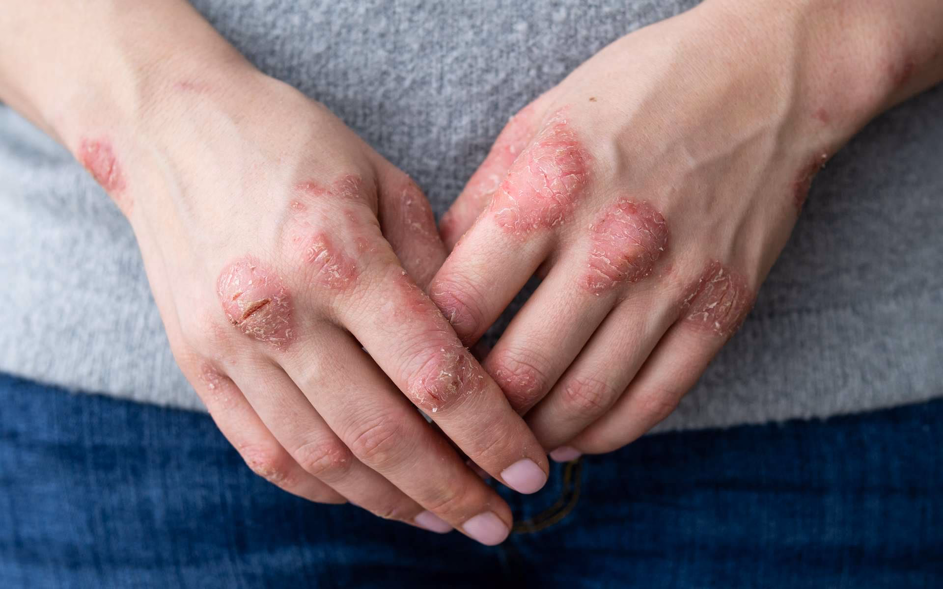 Est-ce que le psoriasis est héréditaire ?