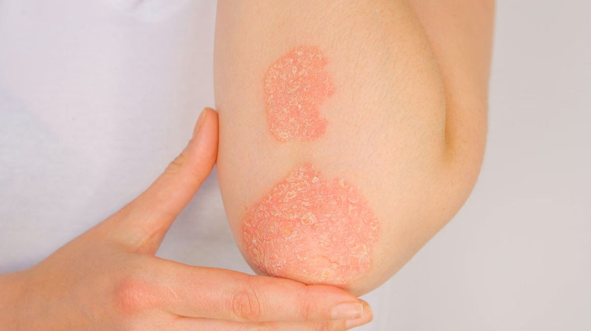 Qu'est-ce que le psoriasis arthropathique?