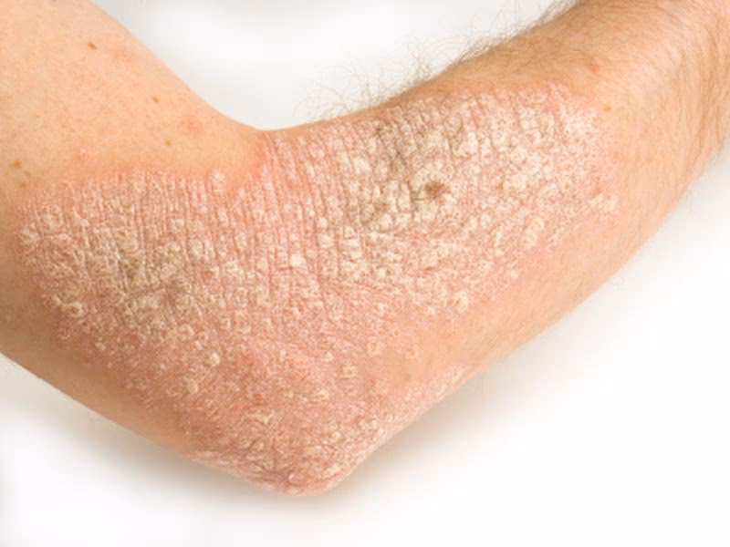 Can psoriasis medications help with fatigue?