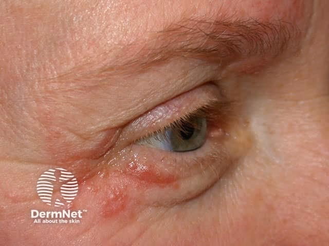 How do you treat psoriasis around your eyes?