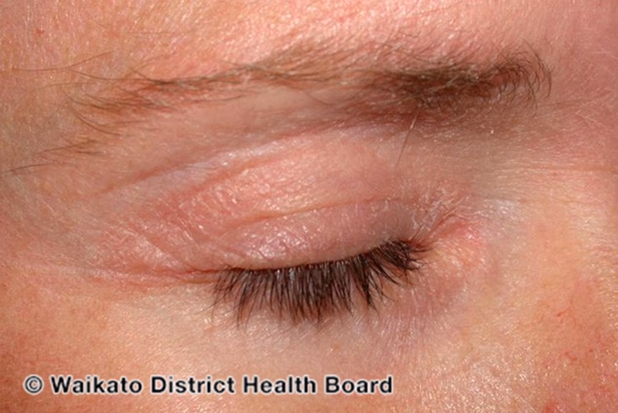 Can psoriasis cause eye problems?