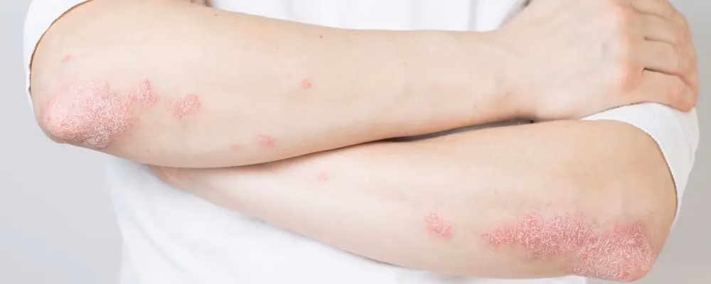 How do I know if I have elbow psoriasis?