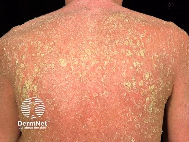 How common is Erythrodermic psoriasis?