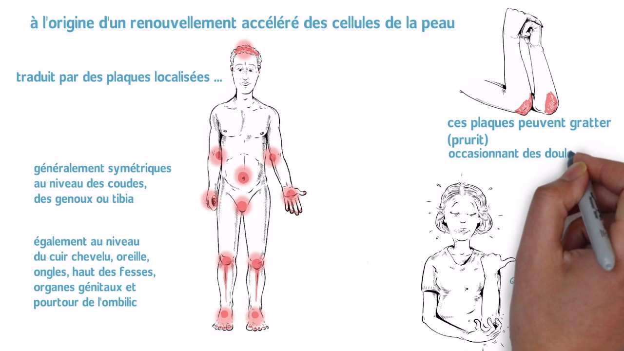 Qu'est-ce que le psoriasis dans le dos ?