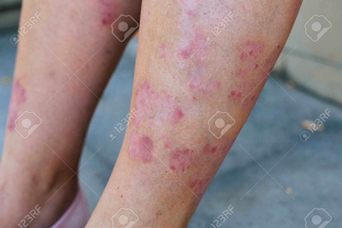 Qu'est-ce que le psoriasis aux jambes ?