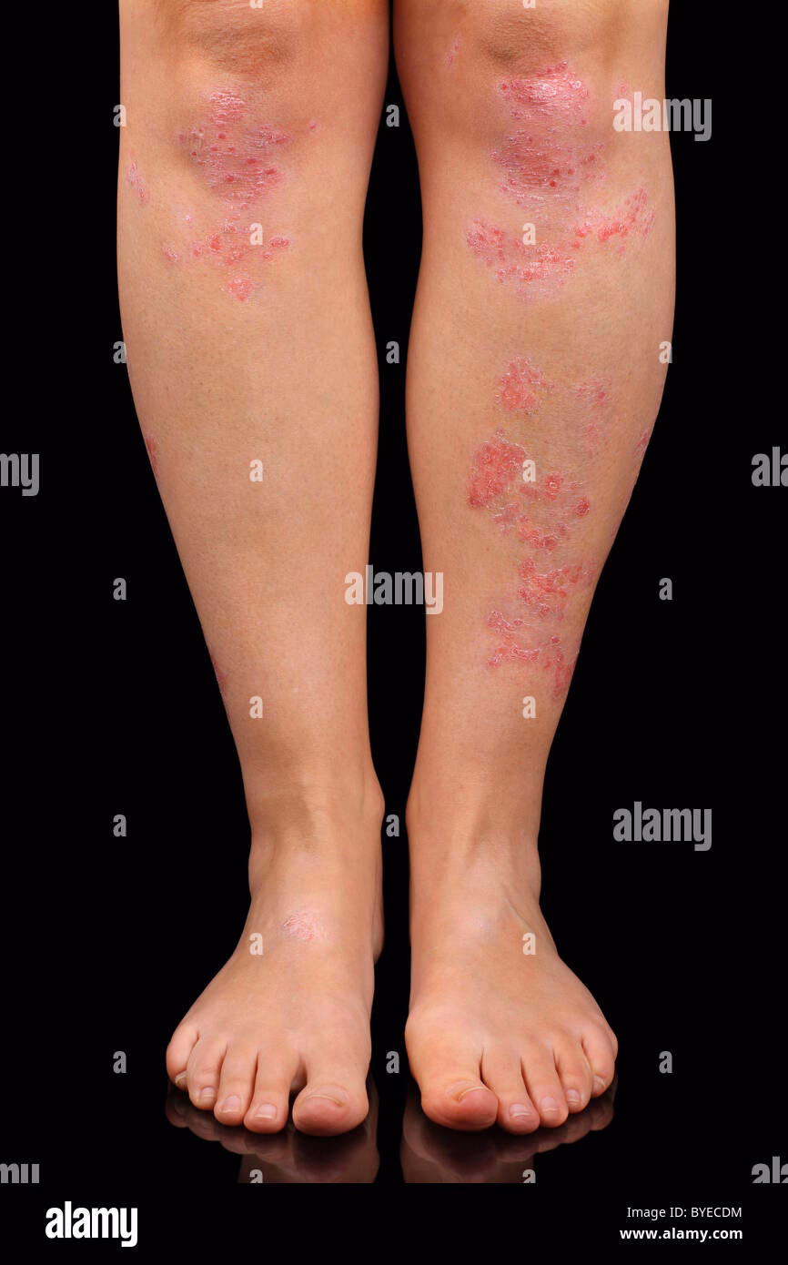 Quels sont les symptômes du psoriasis pustuleux ?