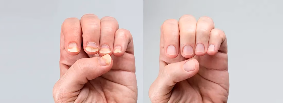 What are the symptoms of nail psoriasis?