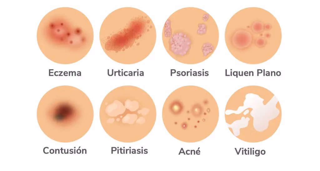 ¿Qué pasa si tengo hongos en las uñas de los pies y psoriasis?