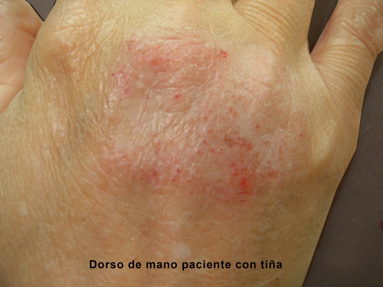 ¿Cuál es el tratamiento para la psoriasis?