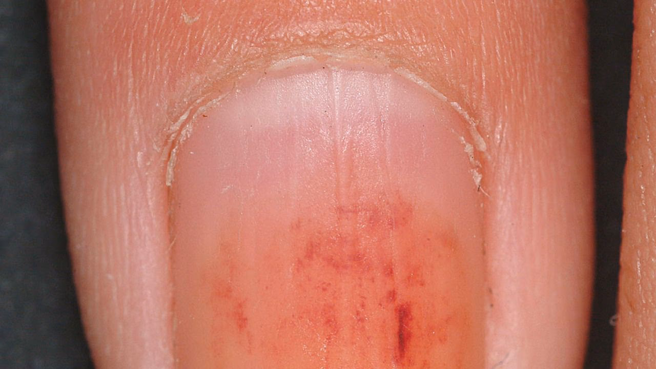 Was ist ein Ölfleck in der Dermatologie?