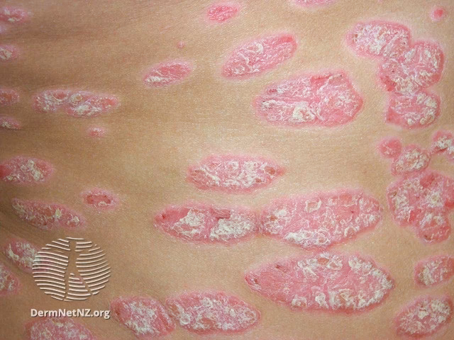 Can a dermatologist tell if you have psoriasis or melanoma?