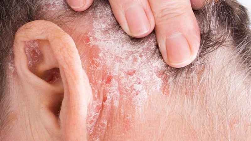 ¿Qué es la psoriasis en placa?