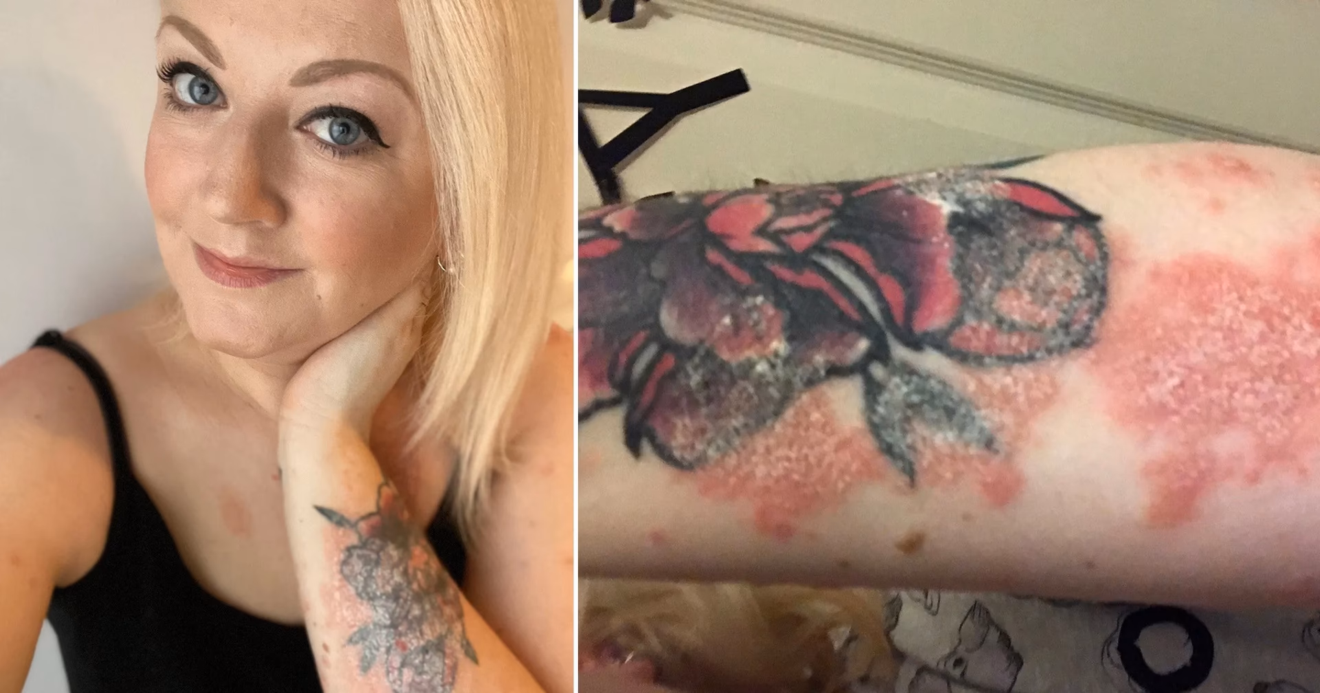Can a tattoo cause psoriasis?
