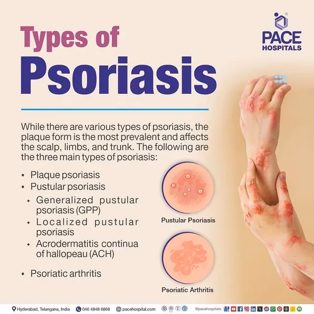 What should I do if I have scalp psoriasis?