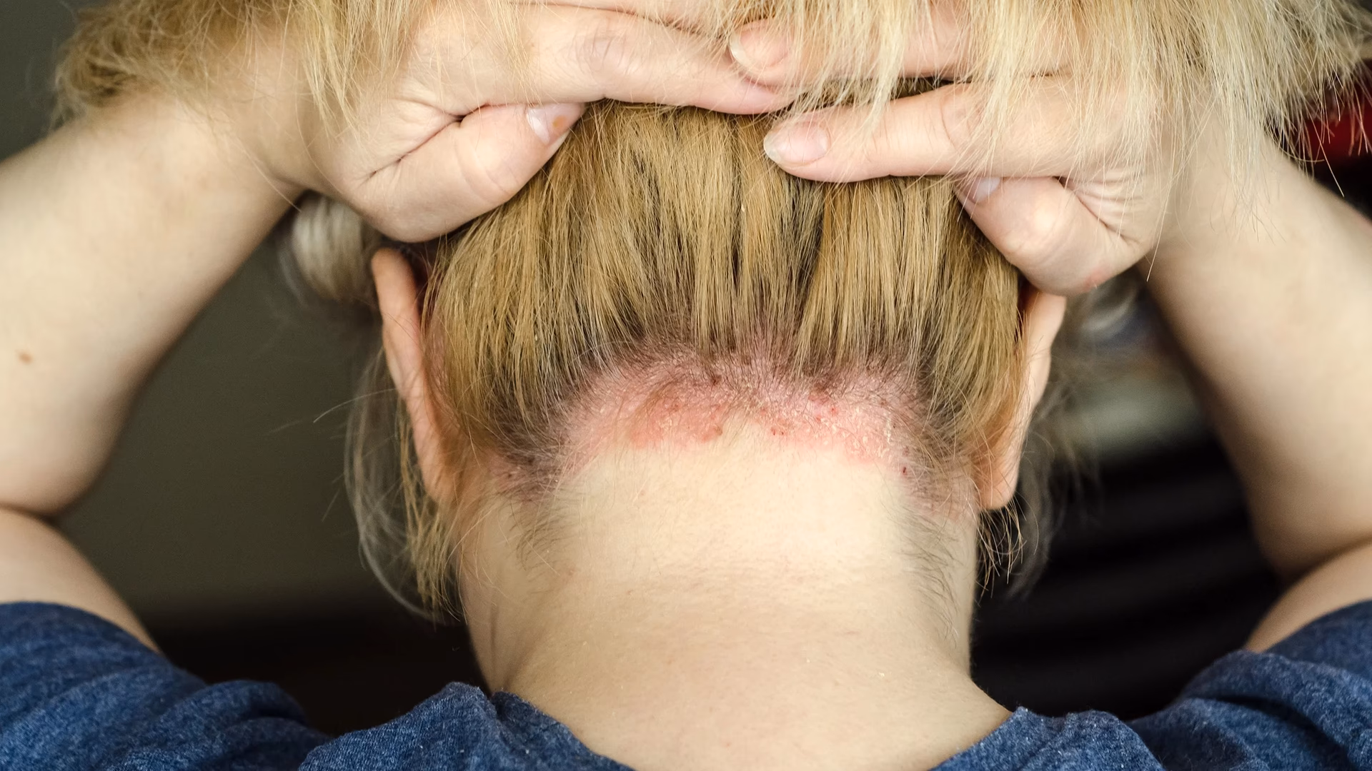 Does Semaglutide help psoriasis?