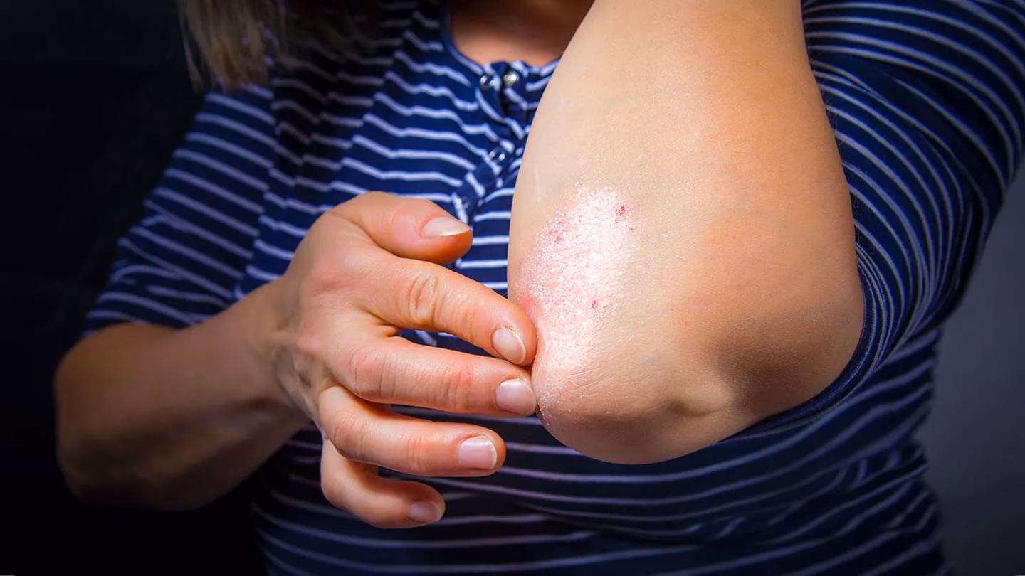 What do psoriasis patches look like?