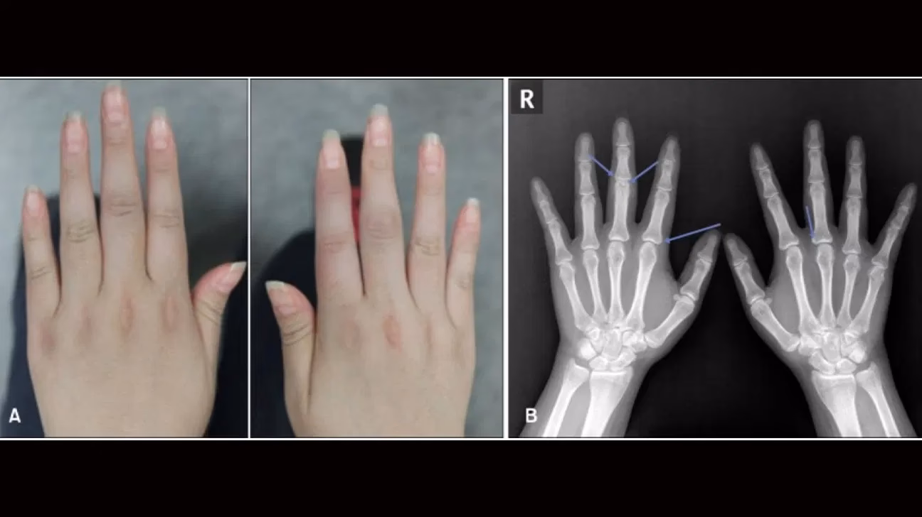 What does a psoriatic arthritis radiograph show?