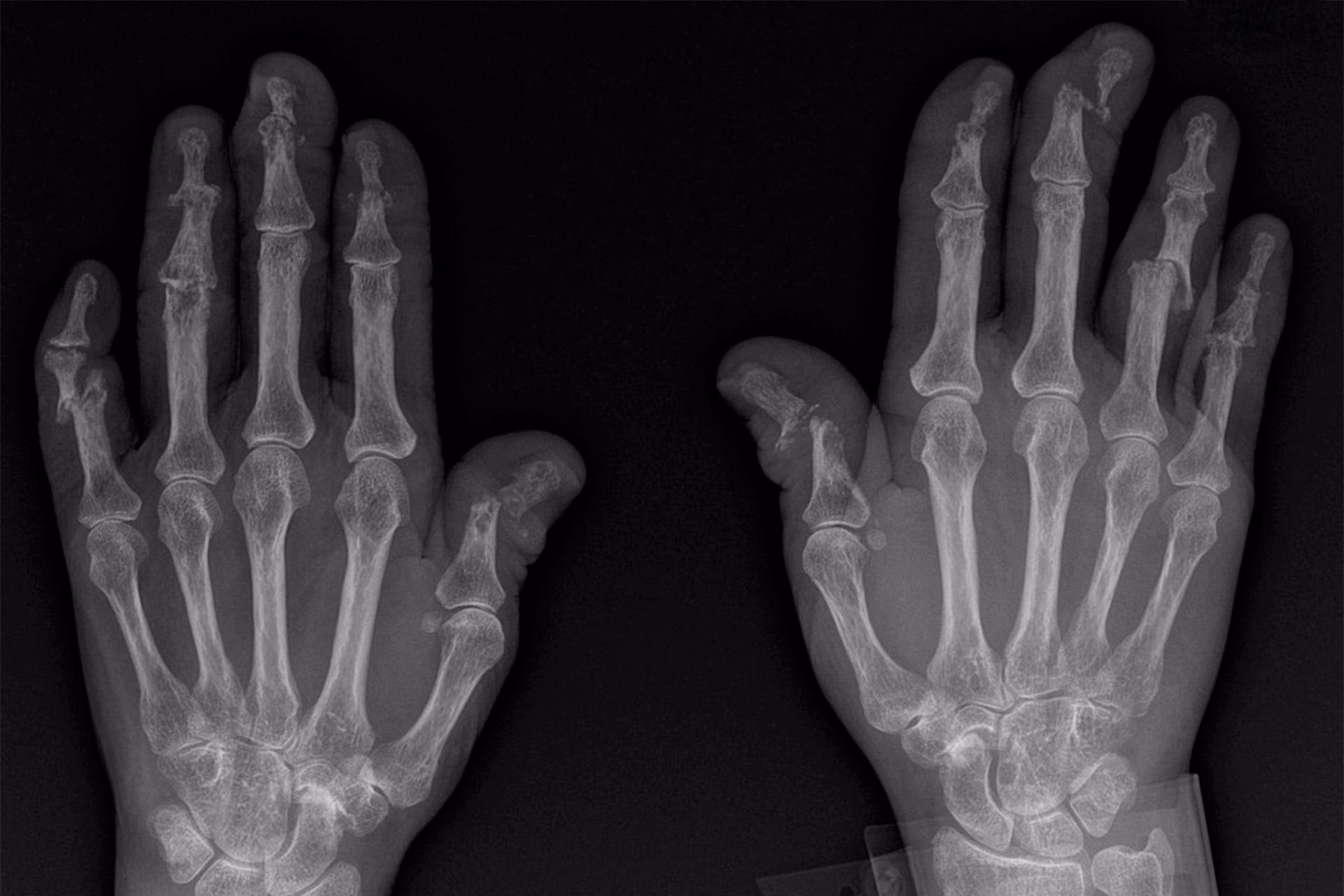 Can a CT scan detect psoriatic arthritis?