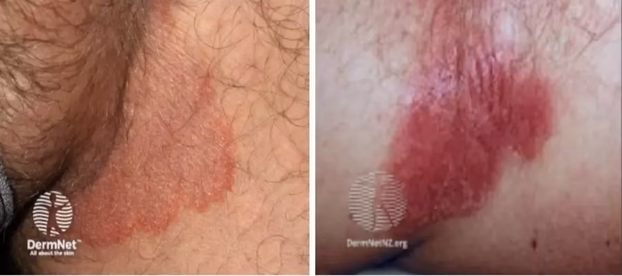 Can psoriasis cause thrush?