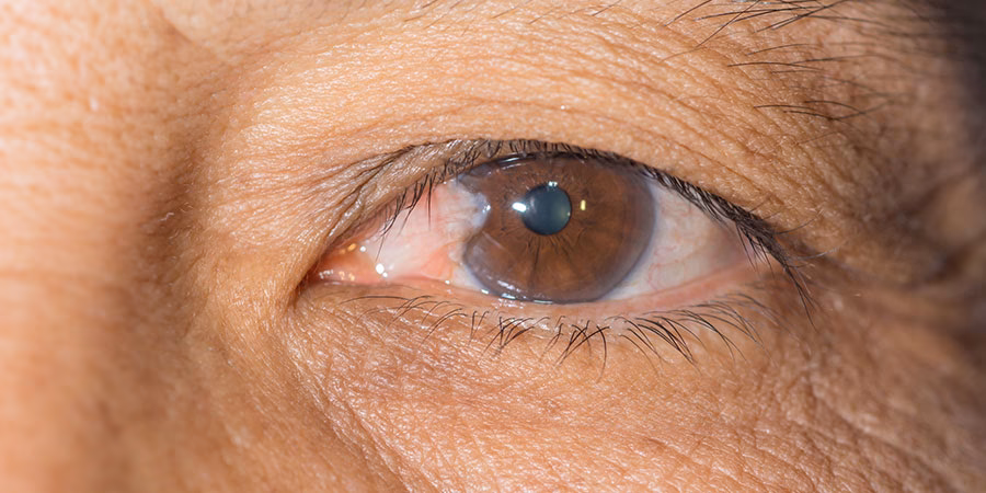What is a pterygium?