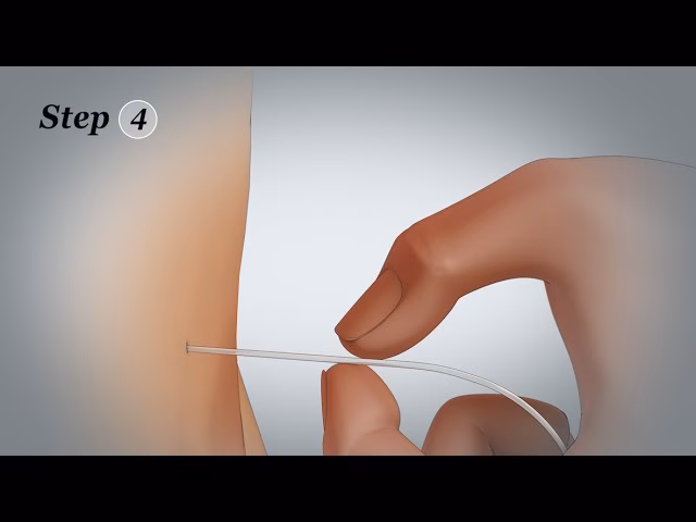 What is the on-Q painbuster® elastomeric pump?