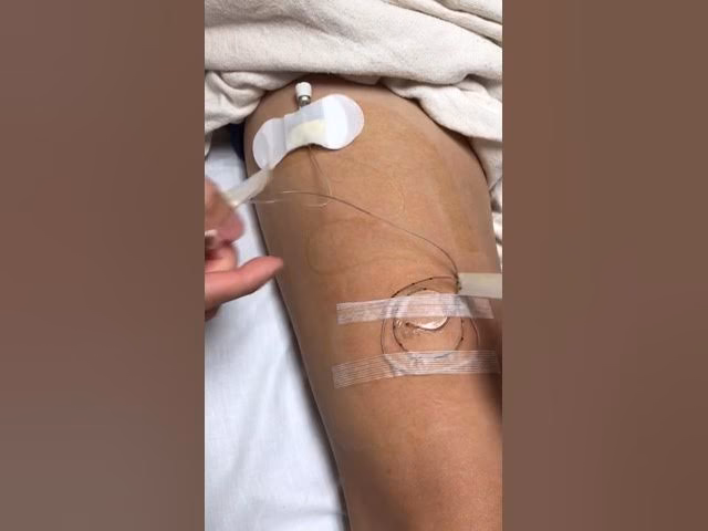 How do you remove a catheter from an infusion pump?